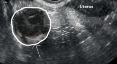 tubo ovarian abscess