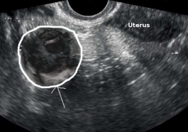 tubo ovarian abscess
