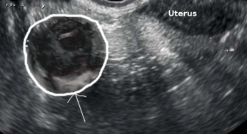 Tubo-Ovarian Abscess: A Serious Female Reproductive Infection