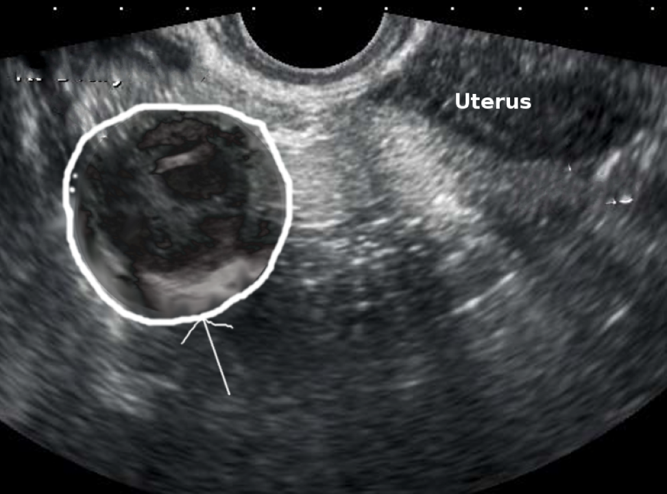 tubo ovarian abscess